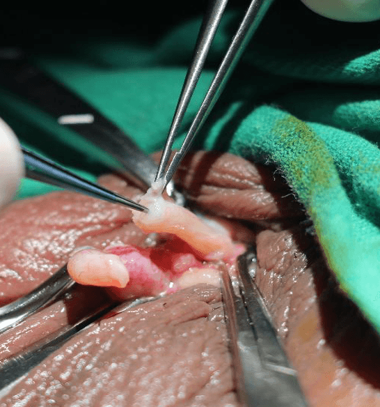 Surgical forceps carefully manipulating a delicate, pale tissue during an operation.